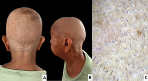 Paciente 2: alopecia areata total A) Vista posterior (occipital). B) Vista temporal (lateral izquierda). C) En la dermatoscópica se muestran múltiples puntos negros y patrón en panal de abejas.