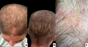 Paciente 3: placas alopécicas circulares en el vértex y la región occipital. A) Vista superior (vértex). B) Vista posterior (occipital). C) Dermatoscopia que muestra puntos negros y amarillos, pelos en tulipán y pelos vellosos.