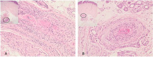 A) y B) En el tejido celular subcutáneo se observan 2 vasos de mediano calibre, que en su pared muestran necrosis fibrinoide, permeación inflamatoria de polimorfonucleares y leucocitoclasia (H&E 40X).