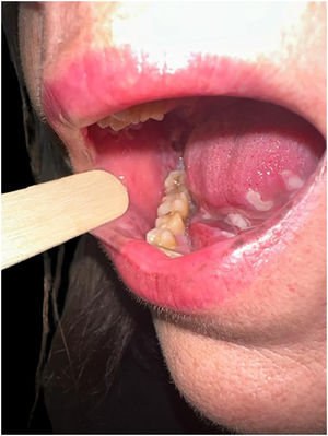 Exulceraciones en la mucosa gingival derecha y el suelo de la boca.
