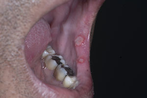 Neutropenia cíclica. Paciente masculino cursando con neutropenia cíclica. En labio mucoso inferior izquierdo presenta 2 úlceras de bordes irregulares, bien definidos, intensamente eritematosos, con fondo blanquecino recubierto por una membrana amarillenta de aspecto fibrinoide.