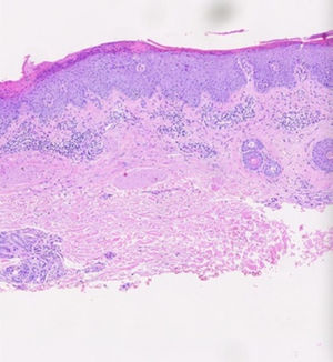 Los cortes muestran un fragmento superficial de piel revestida por epidermis con hiperqueratosis, paraqueratosis con glóbulos de suero y neutrófilos, focal hipogranulosis, acantosis psoriasiforme, espongiosis, exocitosis de linfocitos y algunos queratinocitos apoptóticos; dermis con leve infiltrado inflamatorio mononuclear acompañado de neutrófilos y ocasionales eosinófilos. Los hallazgos histopatológicos podrían corresponder a una reacción psoriasiforme por medicamentos, en un contexto clínico adecuado.