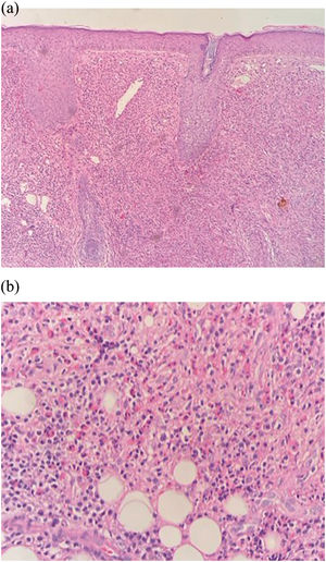 Infiltrado inflamatorio dérmico polimórfico en el cual destacan los eosinófilos y la zona de Grenz.