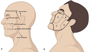 Unidad estética de la mejilla: A) reparos anatómicos que delimitan la mejilla. B) Subunidades estéticas de la mejilla: A. Subunidad infraorbitaria. B. Subunidad cigomática. C. Subunidad bucal. D. Subunidad parotidomaseterina.