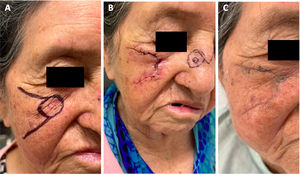 Colgajo de avance de mejilla subunidad infraorbitaria: A) carcinoma basocelular en región infraorbitaria, planteamiento quirúrgico con colgajo de avance de mejilla. B) Colgajo 8 días posoperatorio. C) Resultado estético 21 días posoperatorio.