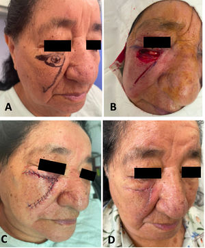 Colgajo de avance y rotación de mejilla subunidad infraorbitaria: A) Carcinoma basocelular en la región infraorbitaria, planteamiento quirúrgico con colgajo de avance de mejilla. B) Defecto quirúrgico y trazo de colgajo de avance de mejilla. C) Vista lateral sutura del colgajo. D) Resultado estético a los 8 días posoperatorio.