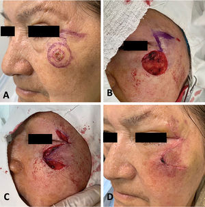 Colgajo de transposición en mejilla subunidad infraorbitaria y cigomática: A) Carcinoma escamocelular en la región infraorbitaria, planteamiento quirúrgico con colgajo de transposición. B) Defecto quirúrgico y trazo de colgajo. C) Vista lateral sutura del colgajo. D) Resultado estético a los 8 días posoperatorio.