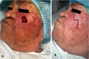 Colgajo de rotación O-Z área infraorbitaria y bucal: A) Defecto de resección de un carcinoma basocelular infiltrante. B) Cierre del colgajo con suturas intradérmicas forma de Z.