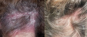 Paciente 2. Imágenes clínicas A) antes y B) después del tratamiento de las lesiones psoriásicas en el cuero cabelludo con calcipotriol/dipropionato de betametasona en crema durante 4 semanas.