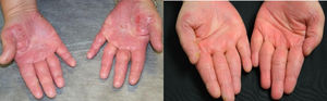 Paciente 4. Imágenes clínicas A) antes y B) después del tratamiento de las lesiones psoriásicas palmares con calcipotriol/dipropionato de betametasona en crema durante 4 semanas.