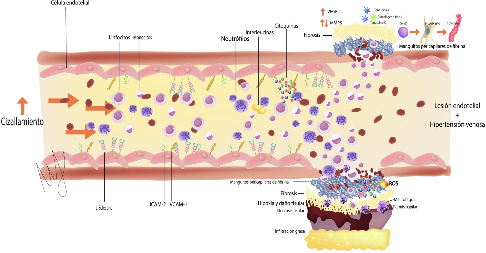 Lipodermatoesclerosis: un enfoque basado en algoritmos | Piel ...