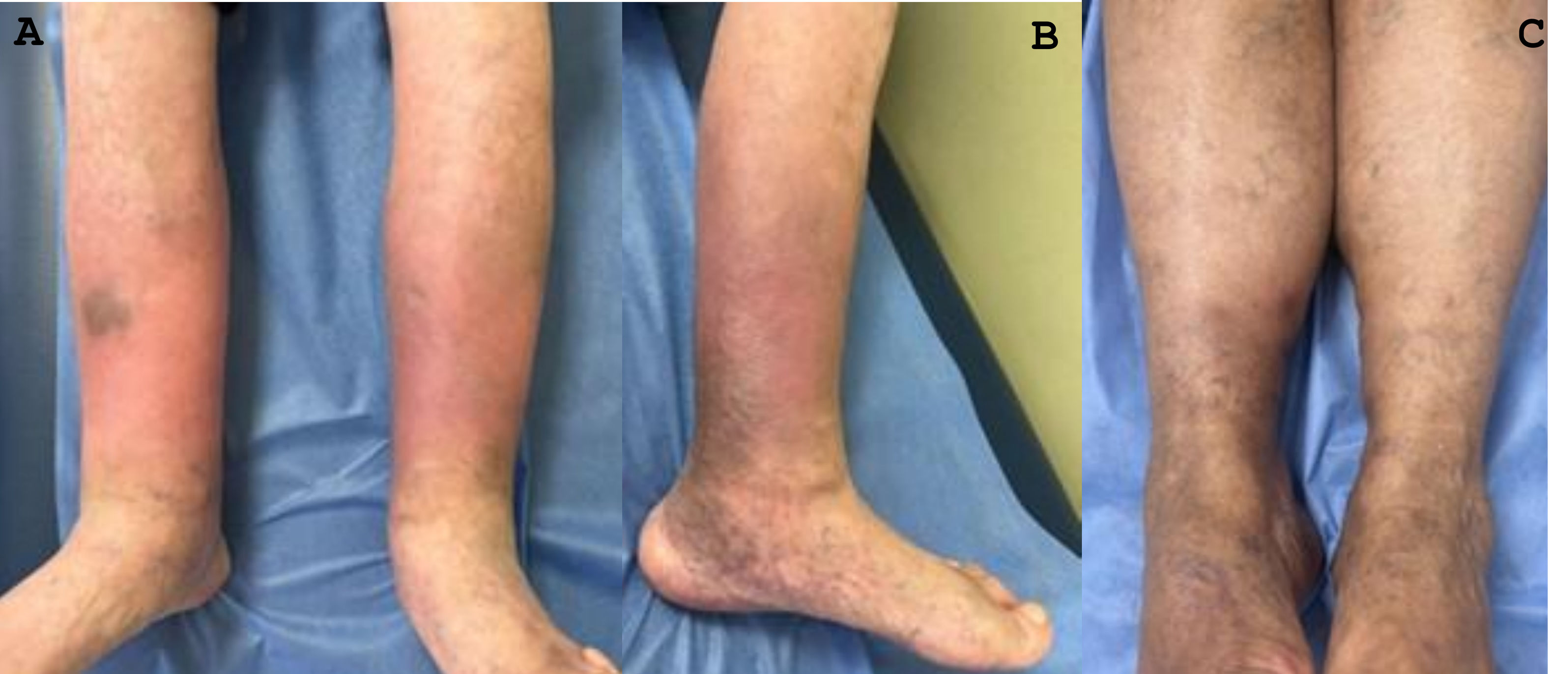 Lipodermatoesclerosis: un enfoque basado en algoritmos | Piel ...