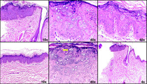 Tinción de hematoxilina y eosina. En los cortes se observan, en la epidermis, queratinocitos con inclusiones víricas, citoplasma granular azulado, gránulos de queratohialina irregulares, refuerzo de la membrana nuclear, vacuolas citoplasmáticas (flecha) y cromatina irregular.