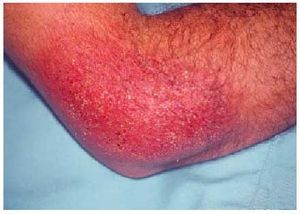 Dermatitis de contacto alérgica e irritativa en región vulvar. Impacto de  los jabones íntimos