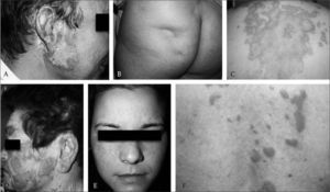 A. LECC. Lesión tipo lupus eritematoso discoide; B: Paniculitis lúpica. Depresión cutánea por atrofia del panículo adiposo; C: LECS anular. Lesiones de morfología anular en la espalda; D: LECS psoriasiforme. Placas eritematoescamosas en la cara; E: Pápulas y maculas eritematosas en el dorso de la nariz y las mejillas configurando el clásico rash malar; F: Lupus túmido. Pápulas y placas eritematosas infiltradas en la espalda.