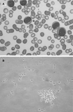 Leukemic pDCs (A) detected in a patient's peripheral blood sample (Hematoxilin staining) have a large size and blastic-like appearance, some of them with pseudopodia. A basophilic cytoplasm includes some granules and vacuoles. In B, isolated LpDCs cultured in vitro in the presence of IL-3 acquire a typical plasmacytoid morphology and form cellular aggregates as their normal counterparts.