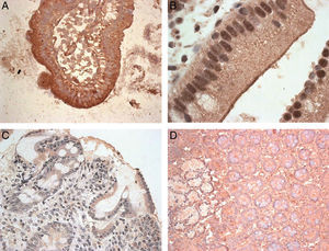 Expression of MICA in gut biopsies of CD patients. Footnote: A. MICA high-intensity stain in an intestinal villus from a patient with mild mucosal damage. B. Detailed image of enterocytes with an apical MICA expression pattern. C. Gut mucosa with severe damage. The level of expression of MICA is clearly lower than that in the MMD image. D. Normal gut mucosa.