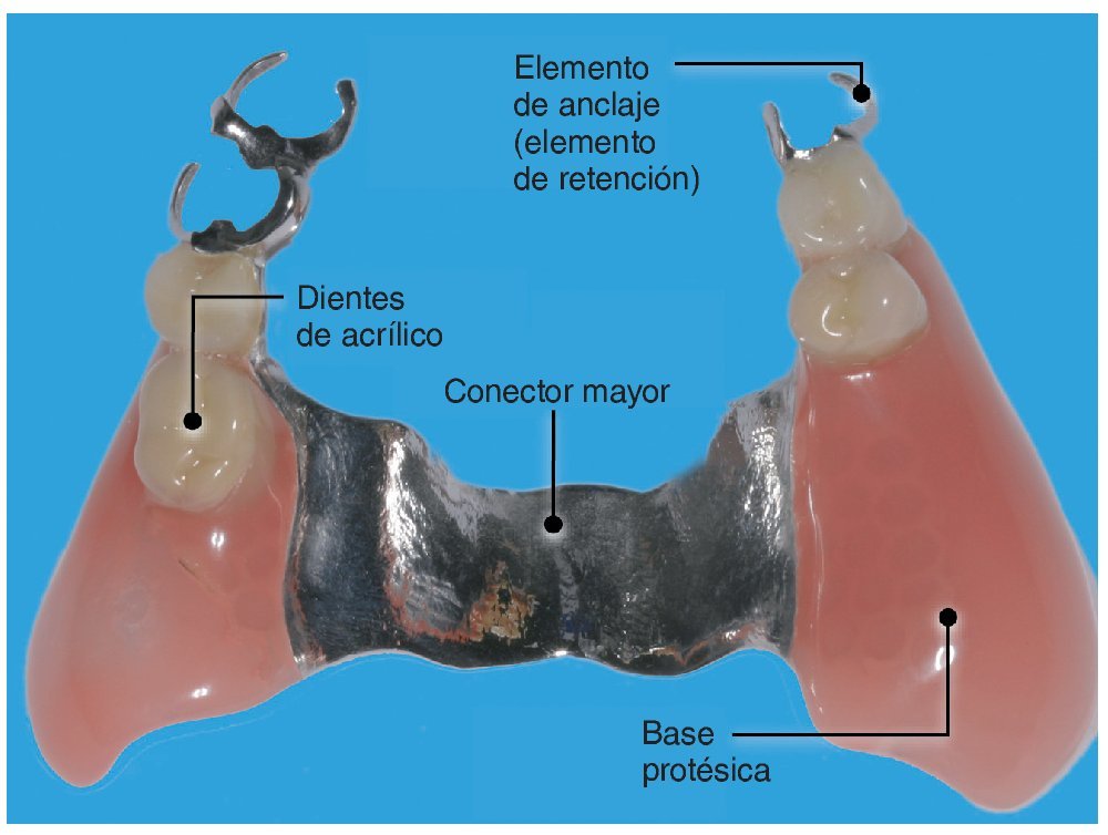 Principios B sicos De La Planificaci n De Pr tesis Removibles Principios B sicos De La Planificaci n De Pr tesis Removibles