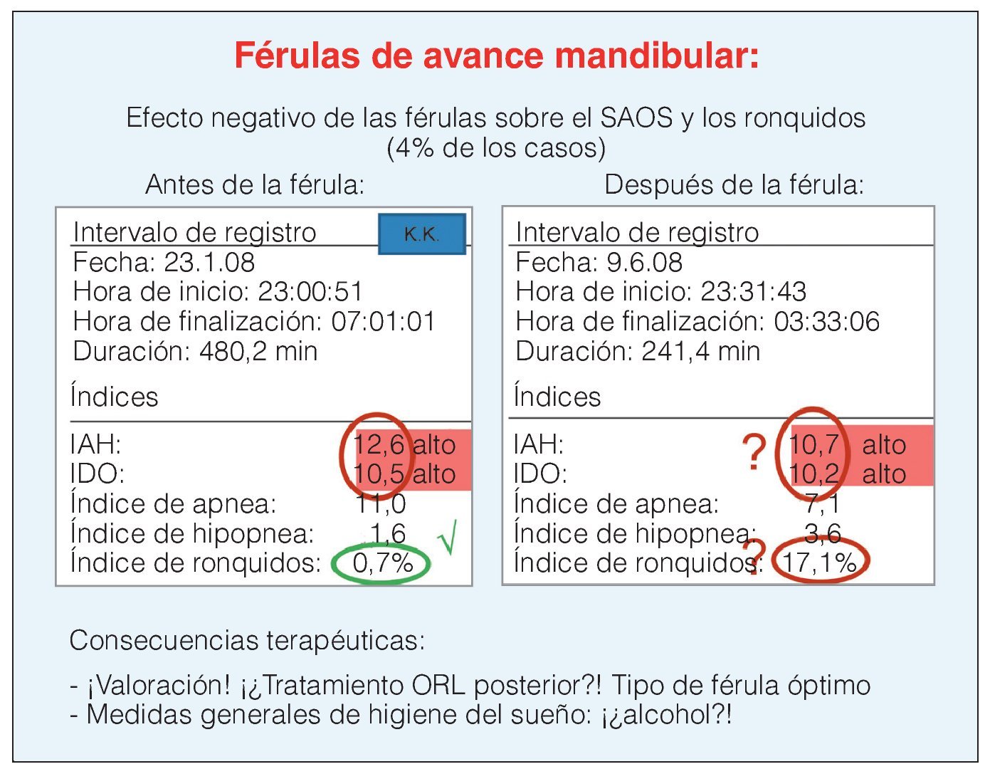 Férula Anti-Ronquidos, tratamiento de la apnea del sueño en Jaén - Clínica  Dental Jaén