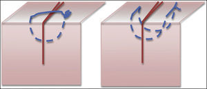 Sutura de puntos simples (izquierda) y sutura de colchonero (derecha).