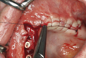 Sutura continua (cruzada) después de la colocación de varios implantes en el maxilar.