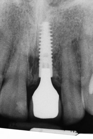 La radiografía de control practicada 3 años después de la colocación del implante muestra un estado óseo pe riimplantario estable.