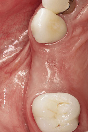 Déficit de tejido blando lateral en la zona premolar derecha antes de la exposición del implante.