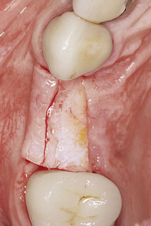 El tejido conjuntivo palatino pediculado junto al colgajo vestibular se puede utilizar para reconstruir la papila interimplantaria y para ganar volumen en la zona lateral.