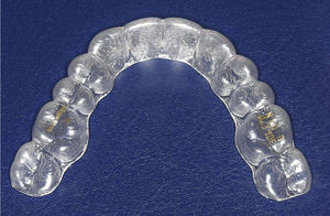 Alineador removible.