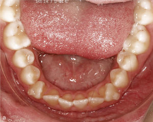 Vista intraoral de arcada inferior con dientes rotados y apiñados, en especial los dientes 33 y 43 (a). Se colocaron ataches en los dientes 33 y 43. Situación intraoral una vez finalizado el tratamiento: arcada conformada tras la desrotación de los caninos y de los incisivos (b).