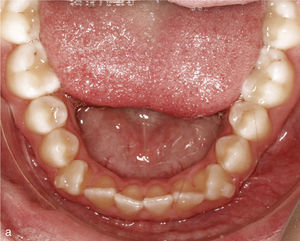 Vista intraoral de arcada inferior con dientes rotados y apiñados, en especial los dientes 33 y 43 (a). Se colocaron ataches en los dientes 33 y 43. Situación intraoral una vez finalizado el tratamiento: arcada conformada tras la desrotación de los caninos y de los incisivos (b).