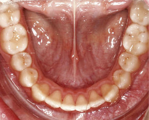 Vista intraoral de arcada inferior con dientes rotados y apiñados, en especial los dientes 33 y 43 (a). Se colocaron ataches en los dientes 33 y 43. Situación intraoral una vez finalizado el tratamiento: arcada conformada tras la desrotación de los caninos y de los incisivos (b).