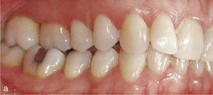 Vista lateral derecha con mordida cruzada del par de dientes 16-46 en una oclusión clase II (a). Situación después de corregir la mordida cruzada y de configurar una oclusión clase I (b).