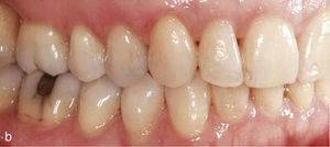 Vista lateral derecha con mordida cruzada del par de dientes 16-46 en una oclusión clase II (a). Situación después de corregir la mordida cruzada y de configurar una oclusión clase I (b).