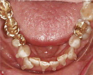 Sector anterior de la arcada inferior con dientes rotados y apiñados (a). La conformación de la arcada se realiza mediante la extracción del diente 42 y la colocación de ataches en los dientes 33 a 44. Vista intraoral de la arcada inferior con un aspecto armonioso y el espacio cerrado (b).