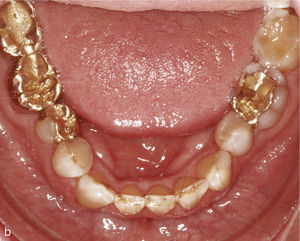 Sector anterior de la arcada inferior con dientes rotados y apiñados (a). La conformación de la arcada se realiza mediante la extracción del diente 42 y la colocación de ataches en los dientes 33 a 44. Vista intraoral de la arcada inferior con un aspecto armonioso y el espacio cerrado (b).