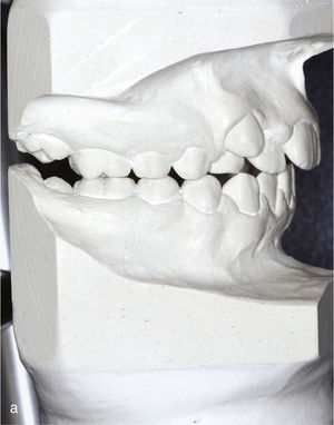 Modelos montados en relación céntrica para la planificación del tratamiento (diente 53 persistente).