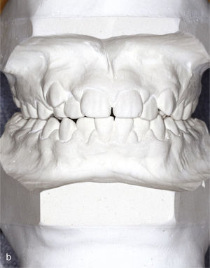 Modelos montados en relación céntrica para la planificación del tratamiento (diente 53 persistente).