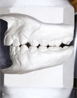 Modelos montados en relación céntrica para la planificación del tratamiento (diente 53 persistente).