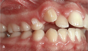 Situación intraoral al inicio del tratamiento con Invisalign y ataches en los dientes 13 y 23 y brackets para elásticos de clase II en los dientes 14, 24, 36 y 46.