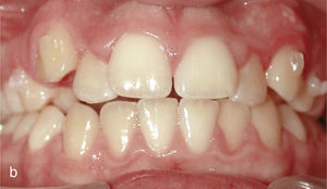 Situación intraoral al inicio del tratamiento con Invisalign y ataches en los dientes 13 y 23 y brackets para elásticos de clase II en los dientes 14, 24, 36 y 46.
