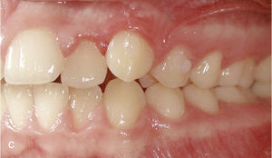 Situación intraoral al inicio del tratamiento con Invisalign y ataches en los dientes 13 y 23 y brackets para elásticos de clase II en los dientes 14, 24, 36 y 46.