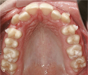 Situación intraoral al inicio del tratamiento con Invisalign y ataches en los dientes 13 y 23 y brackets para elásticos de clase II en los dientes 14, 24, 36 y 46.