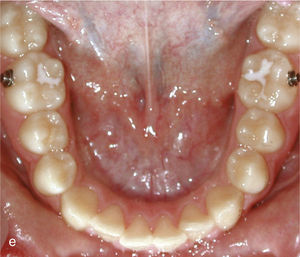 Situación intraoral al inicio del tratamiento con Invisalign y ataches en los dientes 13 y 23 y brackets para elásticos de clase II en los dientes 14, 24, 36 y 46.
