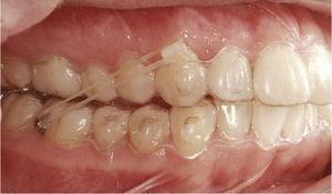 Situación intraoral de un caso clínico similar con brackets en los dientes 13 y 46.