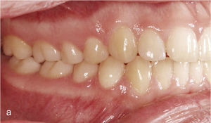 Situación intraoral una vez finalizado el tratamiento con oclusión de clase I, relación intermaxilar anterior fisiológica y guía canina bilateral.