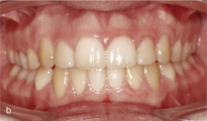 Situación intraoral una vez finalizado el tratamiento con oclusión de clase I, relación intermaxilar anterior fisiológica y guía canina bilateral.