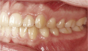 Situación intraoral una vez finalizado el tratamiento con oclusión de clase I, relación intermaxilar anterior fisiológica y guía canina bilateral.