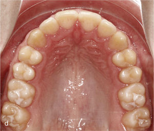 Situación intraoral una vez finalizado el tratamiento con oclusión de clase I, relación intermaxilar anterior fisiológica y guía canina bilateral.