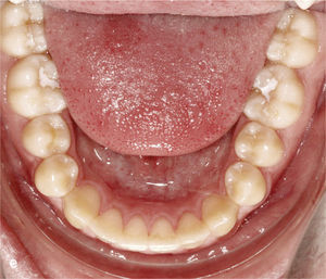 Situación intraoral una vez finalizado el tratamiento con oclusión de clase I, relación intermaxilar anterior fisiológica y guía canina bilateral.